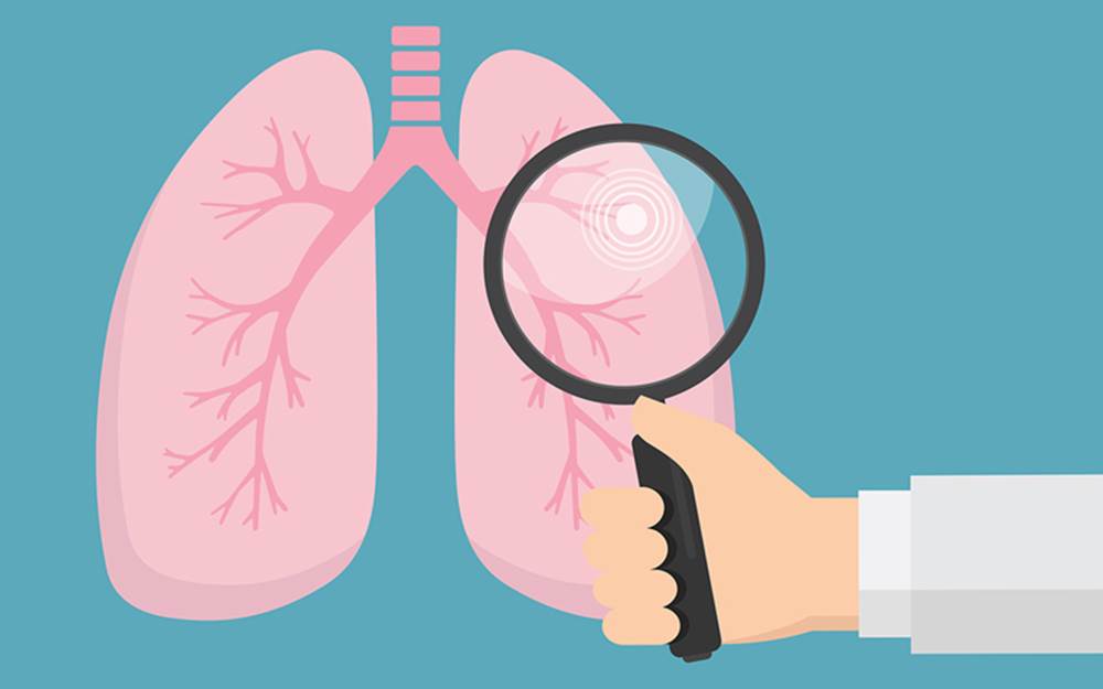 All About Lung Cancer