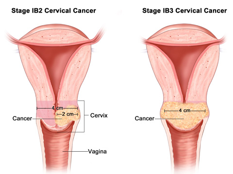 Cervix Cancer