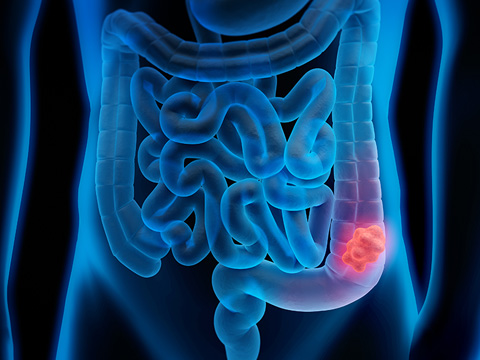 Colorectal Cancer