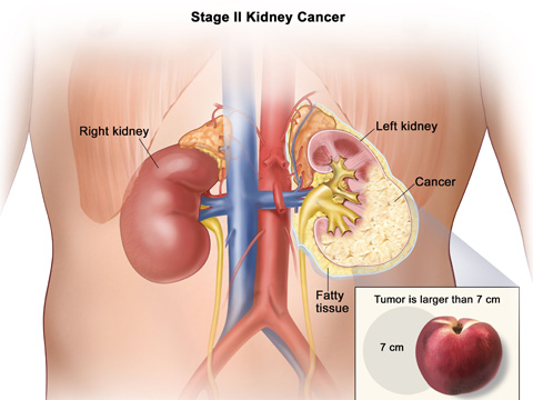 Laparoscopic Kidney Surgery