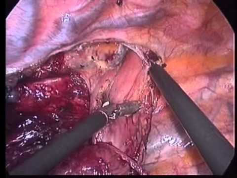 thoraco laparoscopic esophagectomy