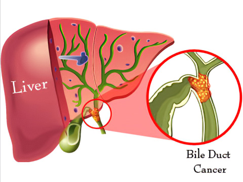 Liver Cancer/ Biliary Tract Cancer