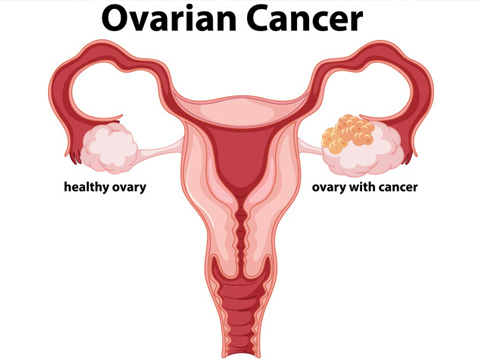 Ovarian Cancer