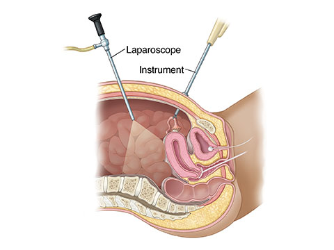 Laparoscopic Pelvic Surgery