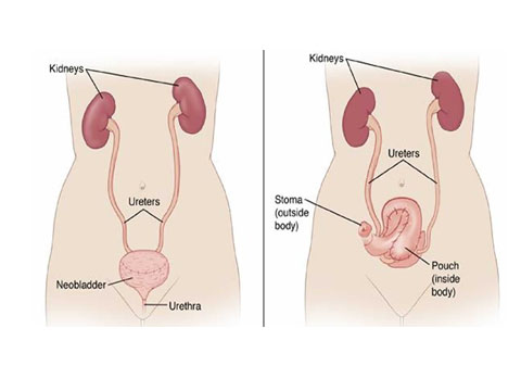 Laparoscopic Radical Cystectomy