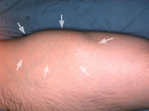 Soft Tissue Sarcoma