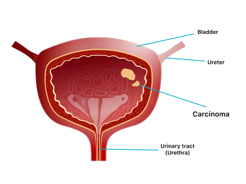 Urinary Bladder Cancer