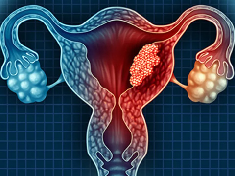 Uterine Cancer