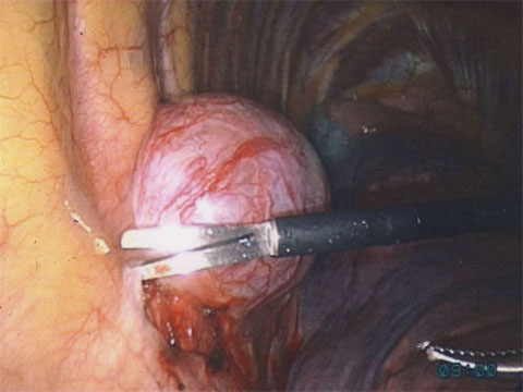 Vats Mediastinal Tumor Surgery