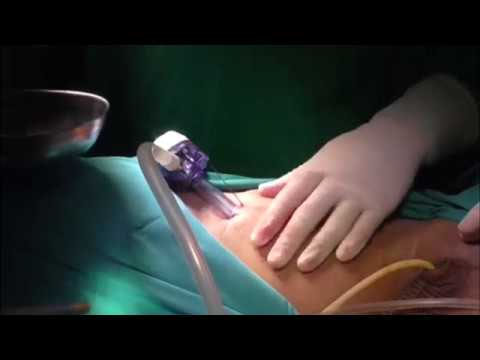 Video Endoscopic Inguinal Lymphadenectomy
